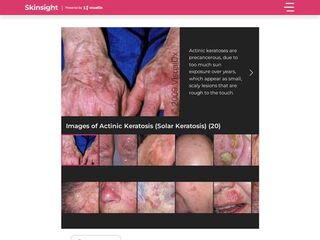Solar Keratosis (Actinic Keratosis)
